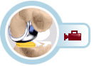 unicondalyerreplacement